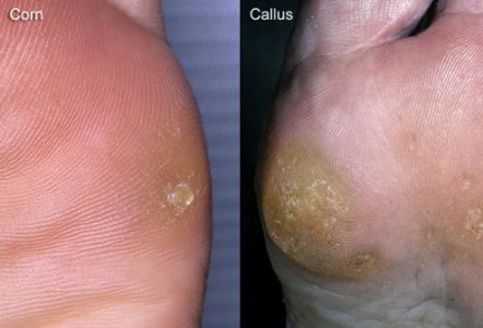 composite_photo_of_corn_and_callus_on_foot.jpg