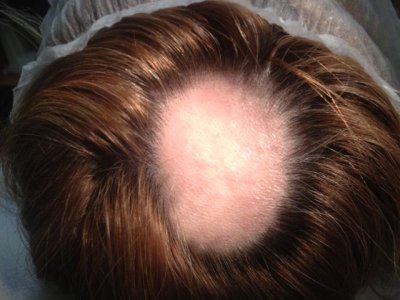 alopecia_femminile_prp_prima.JPG