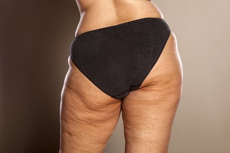 65621590-glutei-femminili-grassi-con-cellulite-e-smagliature-in-mutandine-nere.jpg